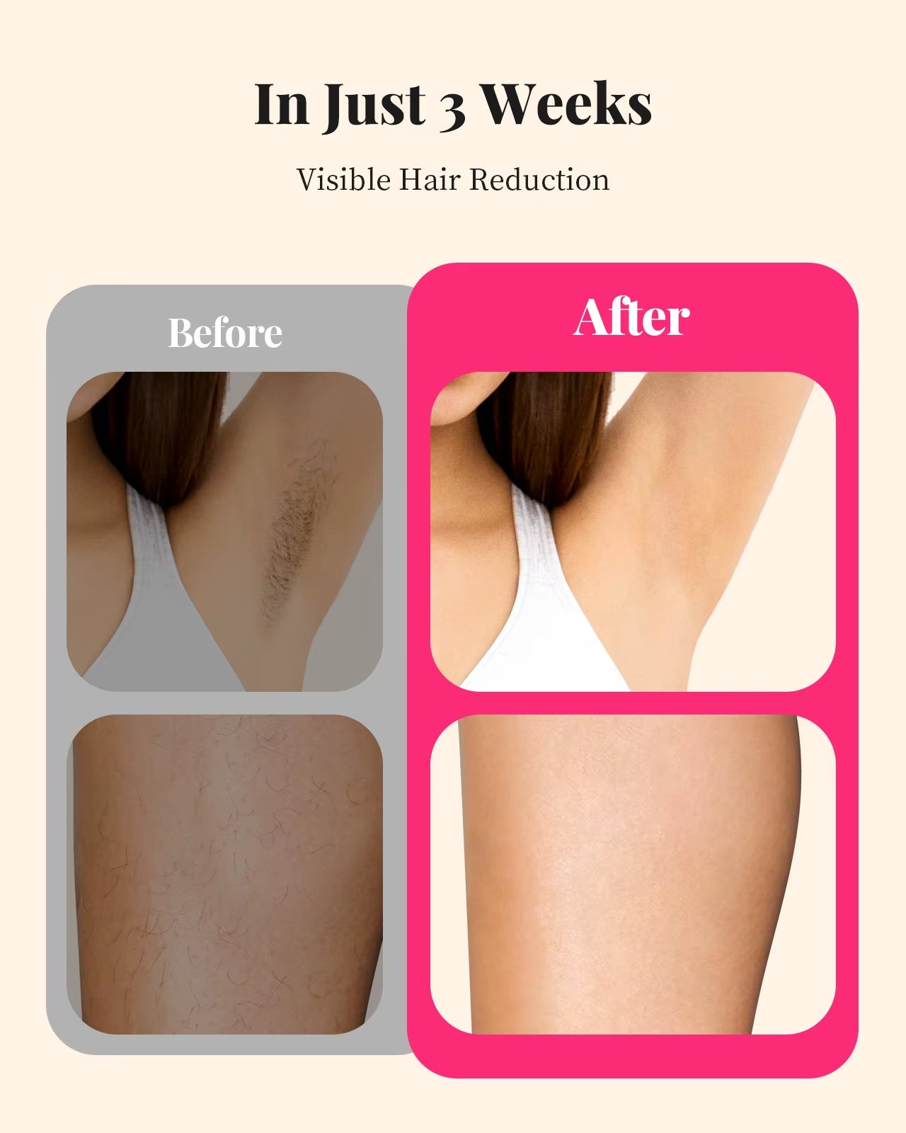 990000 Flashes Hair Removal for Women and Men IPL Hair Removal Body Bikini and Facial Areas Painless Permanent Hairremoval
